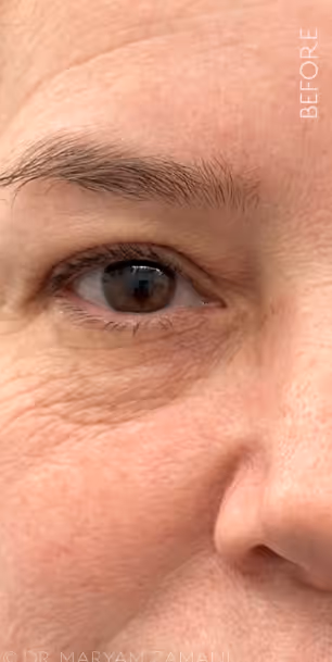 Close-up of a middle-aged person's eye area showing visible wrinkles and fine lines with the word 'BEFORE' on the right side.