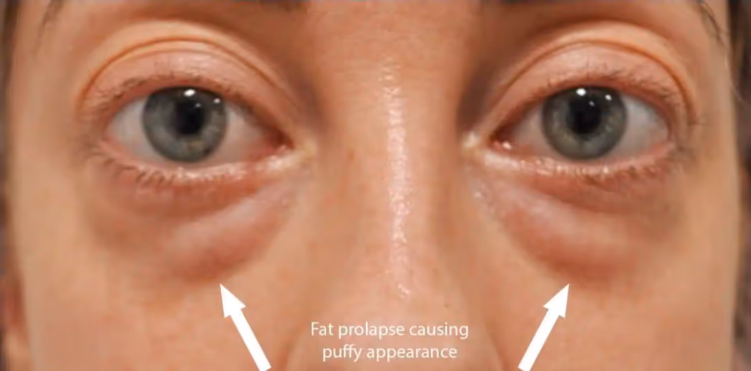 Close-up of eyes showing puffiness under both eyes with arrows pointing to the swollen areas and text indicating fat prolapse causing puffy appearance.