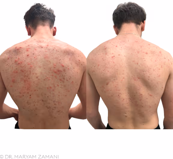 Side-by-side comparison of a male back with acne before and after treatment showing significant reduction in redness and blemishes.