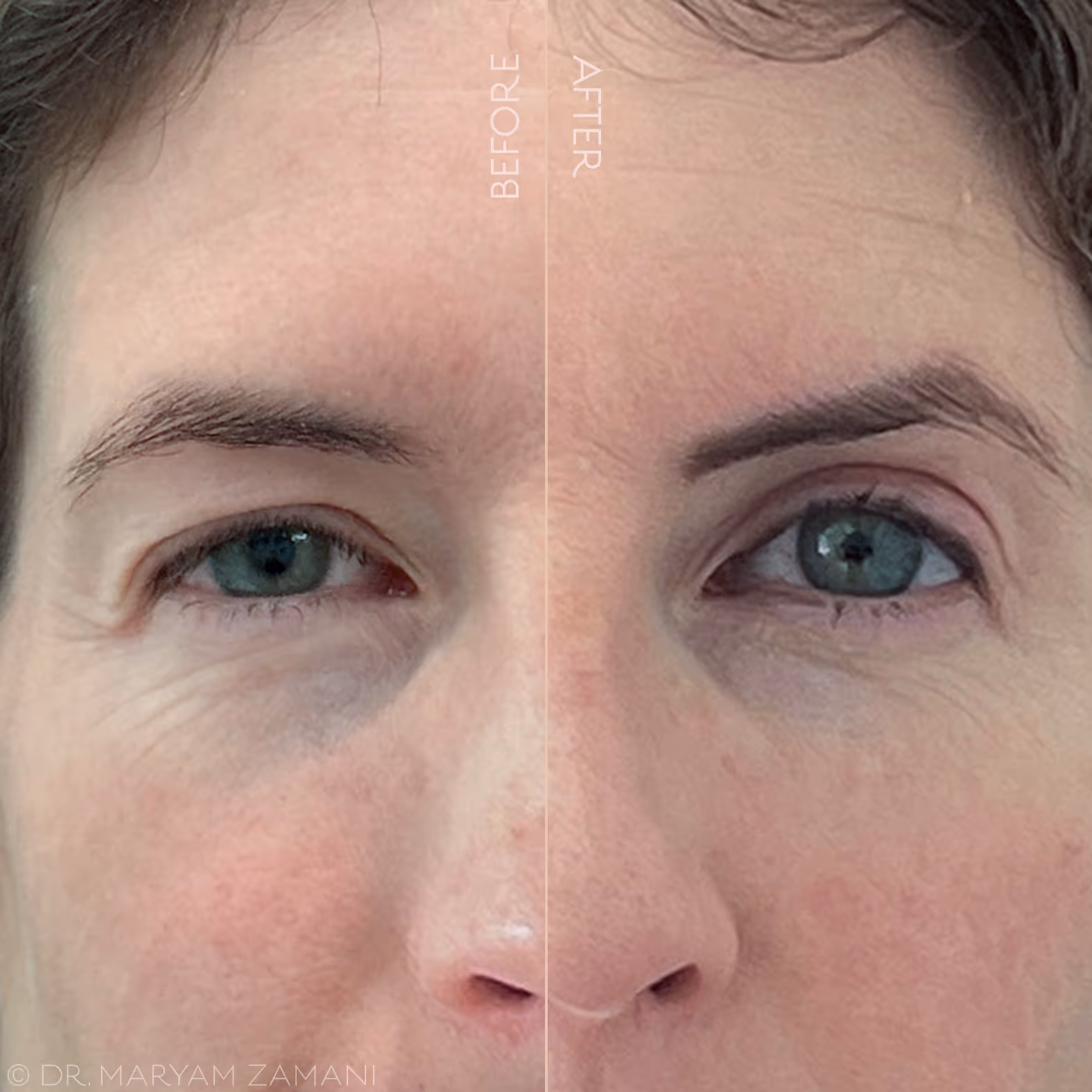 Close-up comparison of a woman's eyes showing reduced wrinkles and smoother skin under the eye on the right side labeled 'after' versus the left side labeled 'before'.