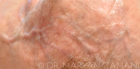 Close-up of skin showing visible veins beneath the surface.