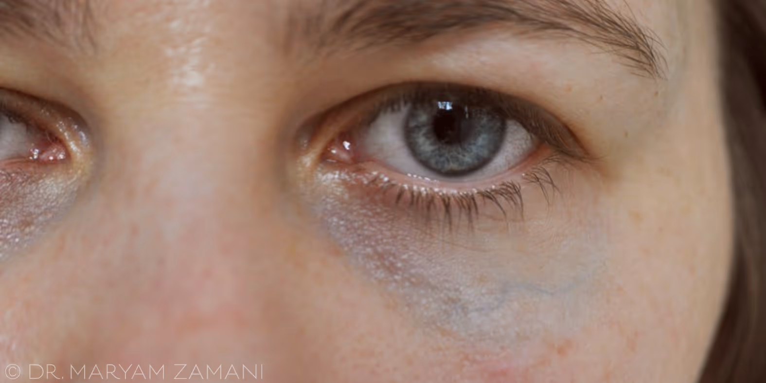 Close-up of a person's face showing a blue-gray eye with subtle dark circles underneath.