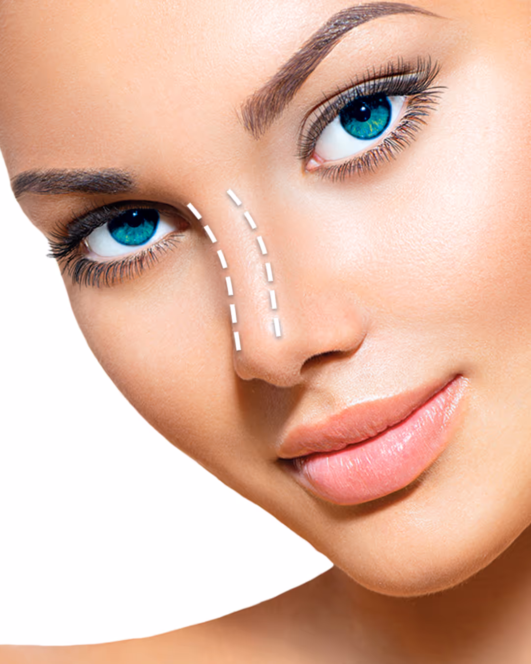 Close-up of a woman's face with blue-green eyes and two dashed lines on the nose indicating a non-surgical rhinoplasty area.