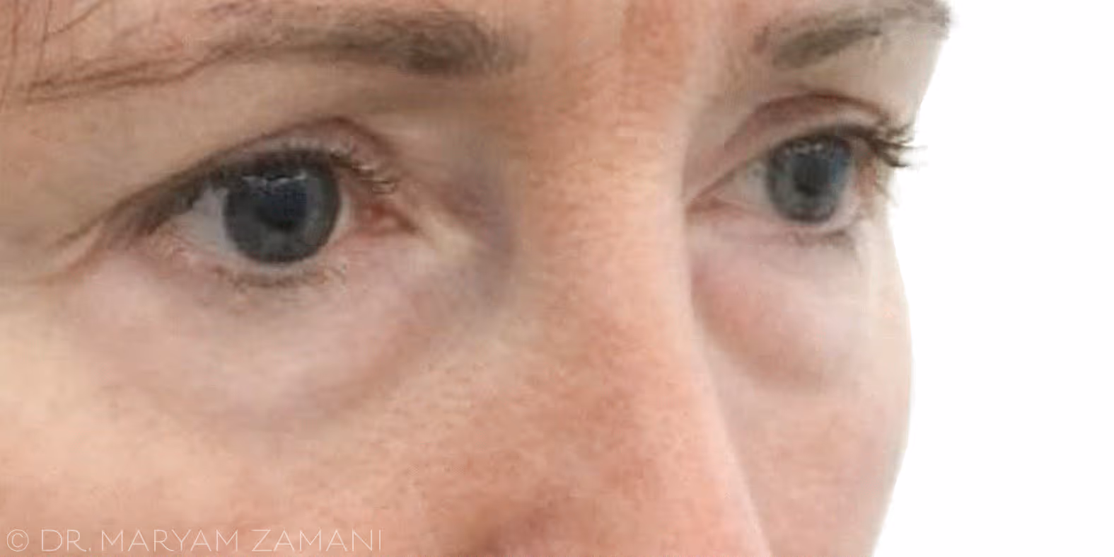 Close-up of a woman's eyes and part of her nose with light skin and faint wrinkles around the eyes.
