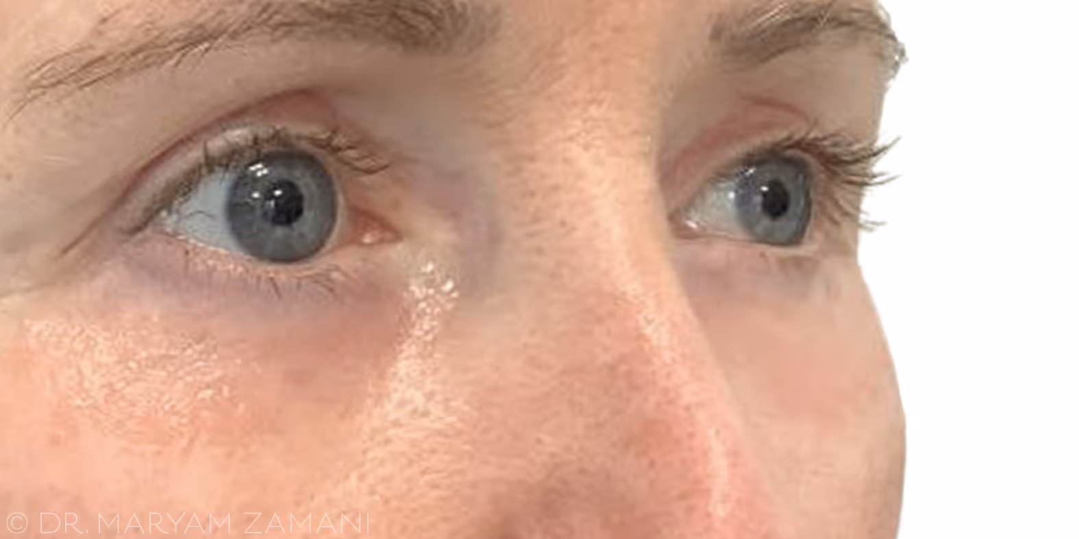 Close-up of a person's face focusing on their blue-gray eyes and the skin around them.
