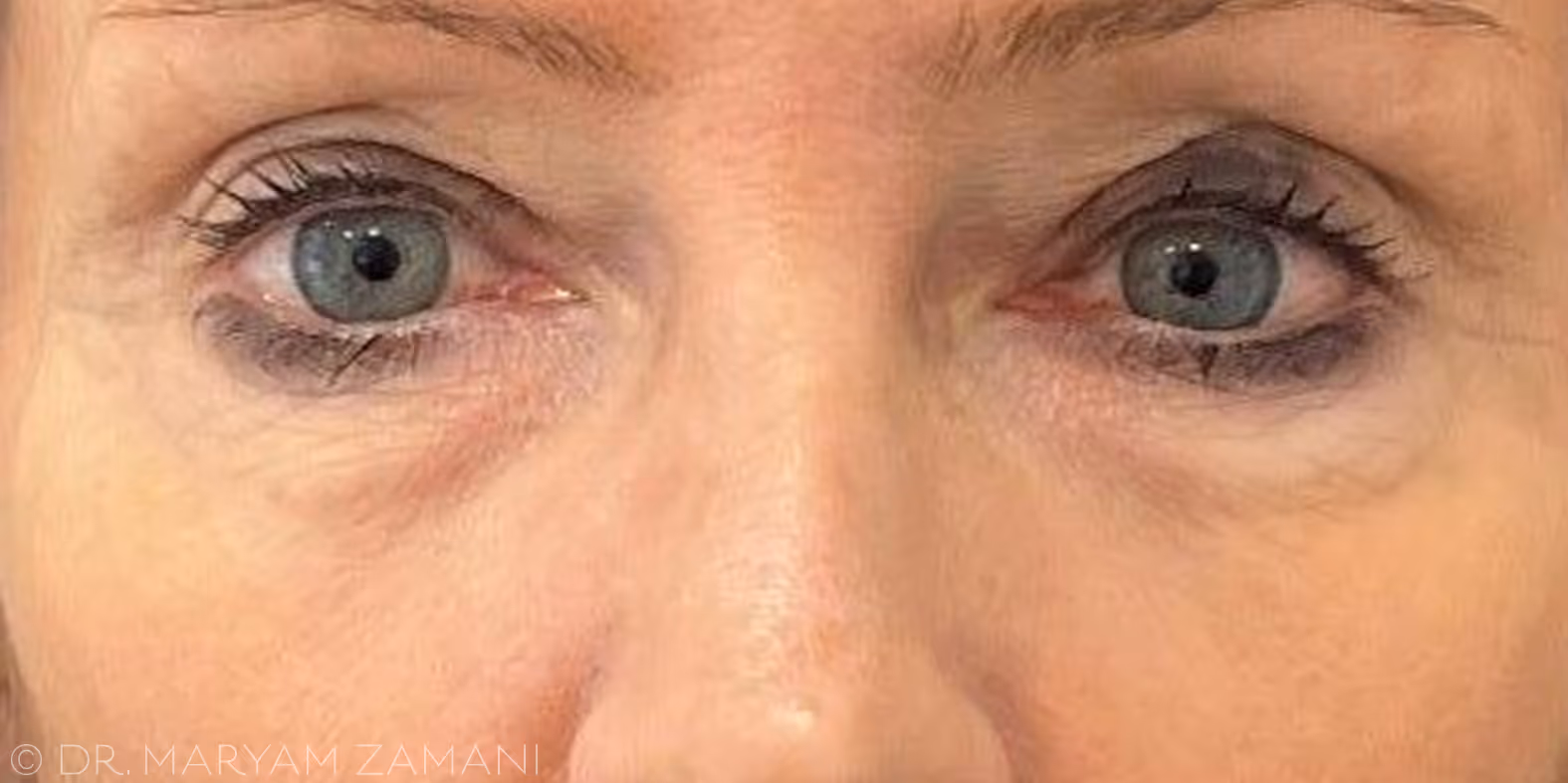 Close-up of a person's eyes with light blue irises, visible wrinkles, and dark circles under the eyes.