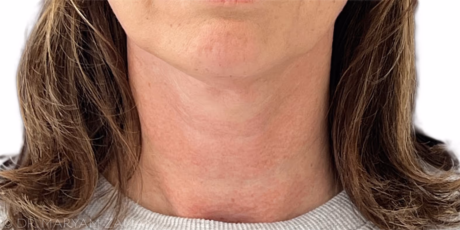 Close-up of a woman's neck and lower face with light brown hair and a grey sweater.
