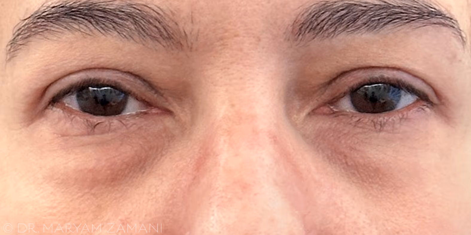 Close-up of a person's eyes showing mild under-eye puffiness and dark circles.