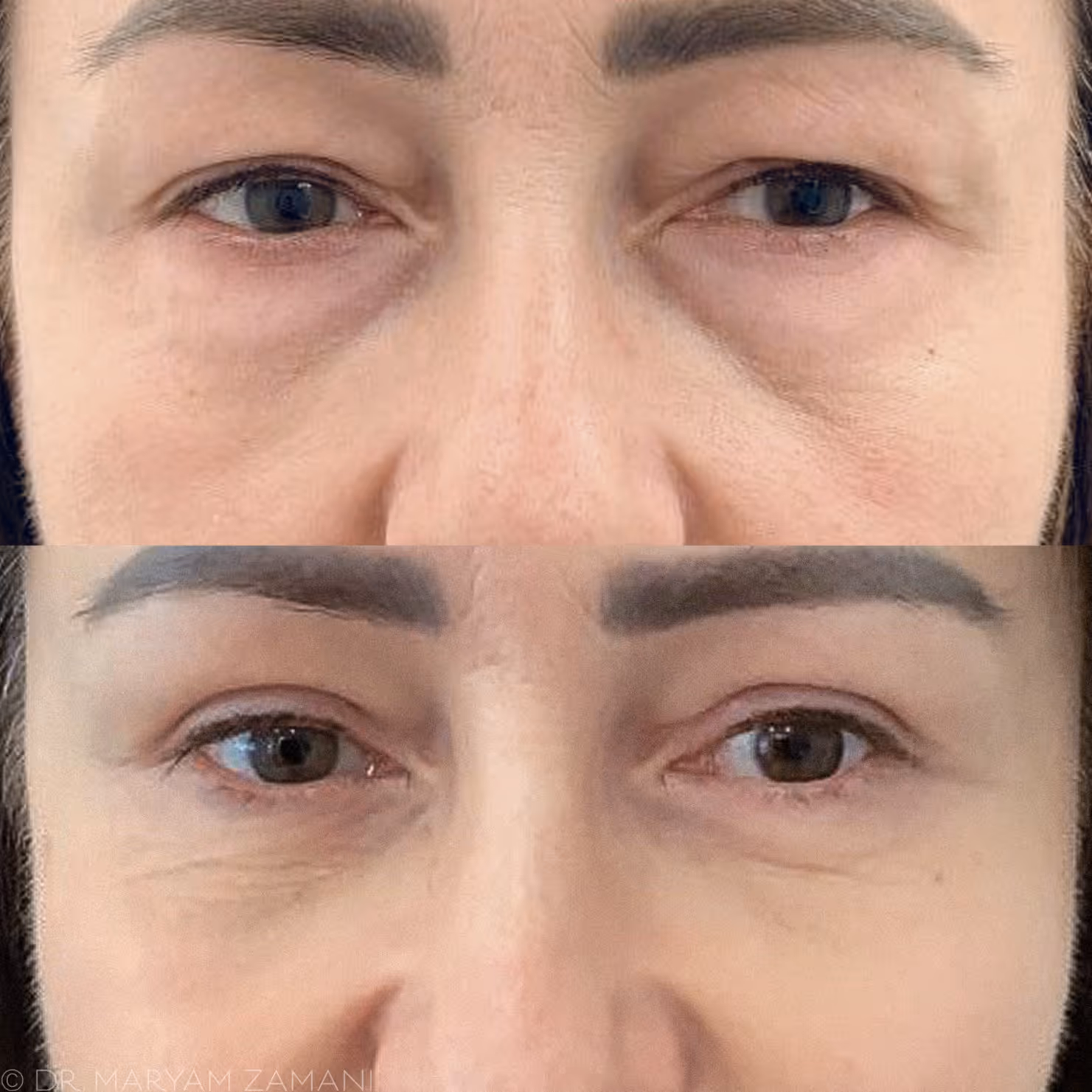 Close-up comparison of a woman's eyes showing reduced under-eye puffiness and smoother skin in the after image.