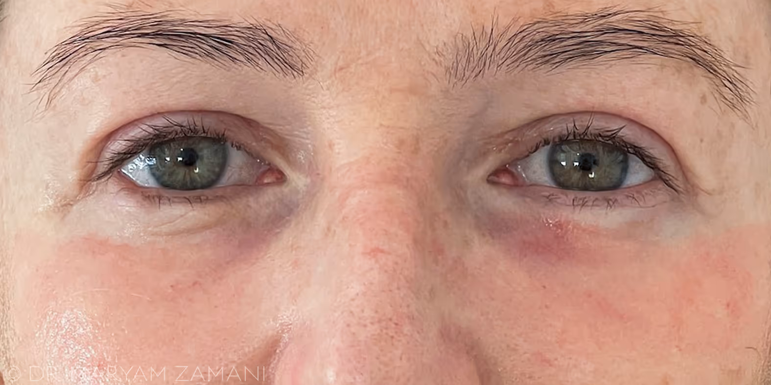 Close-up of a person's face showing green eyes with slight redness and mild dark circles under both eyes.