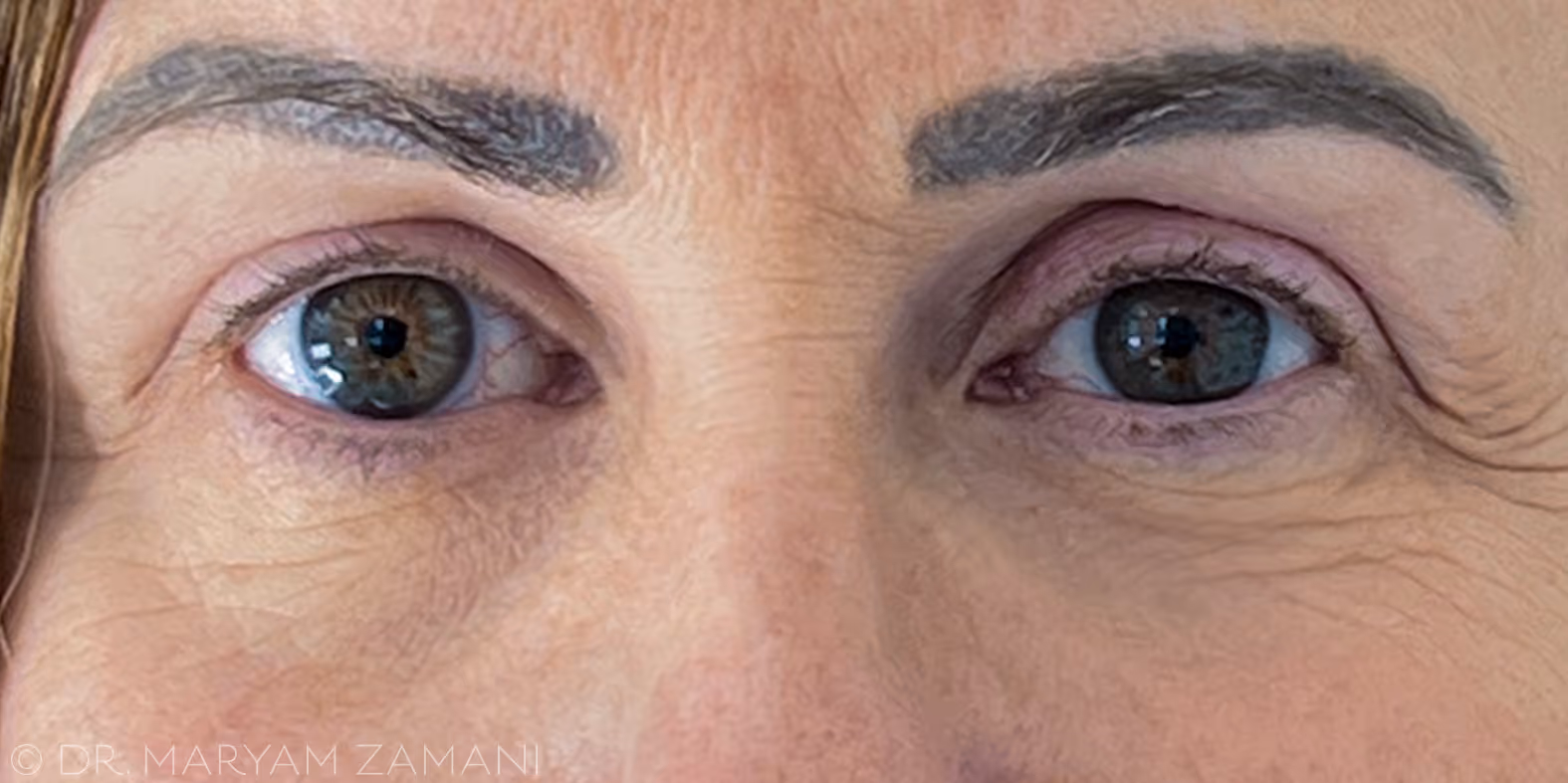 Close-up of a person's eyes showing natural wrinkles and gray-green irises.