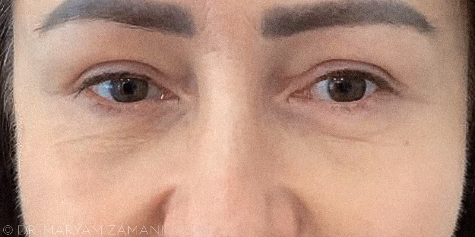 Close-up of a person's face showing eyes and eyebrows with natural skin texture.