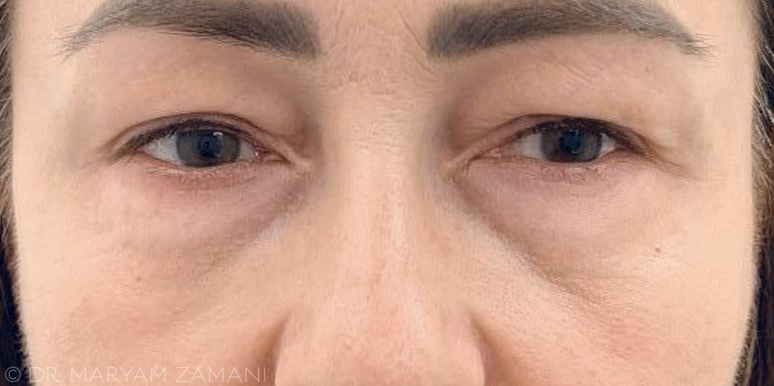 Close-up of a person's eyes and nose showing mild dark circles and fine wrinkles around the eyes.