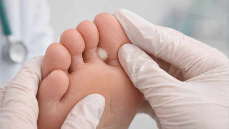 Podiatrist examining soft corn between toes in clinic setting