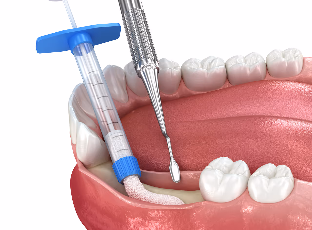 Bone Grafting in Parker, CO