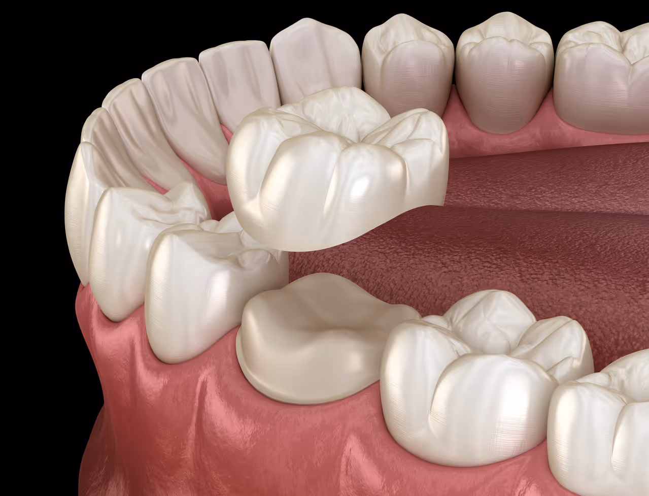 Dental Crowns in Parker, CO