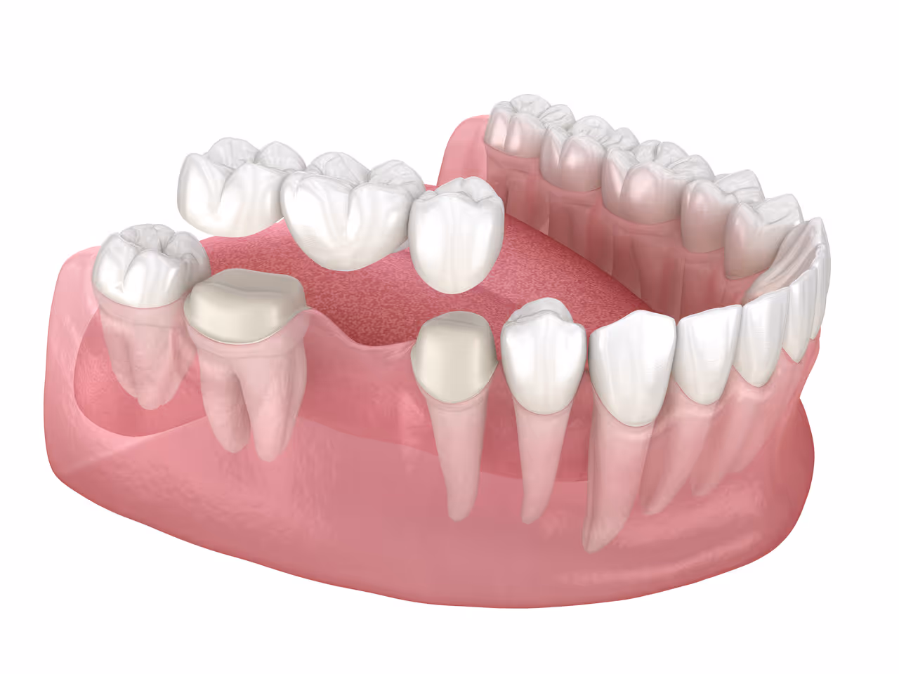 Dental Bridges in Parker, CO