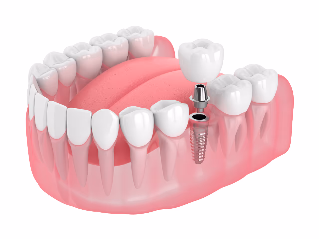 Dental Implant Restoration in Parker, CO