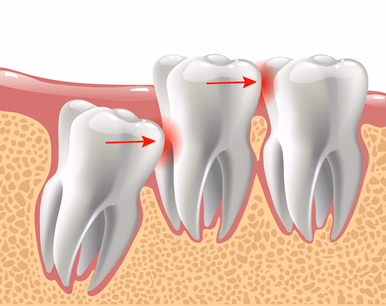 Warning Signs of Impacted Wisdom Teeth