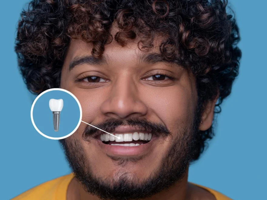 Smiling man with curly hair showing a dental implant illustration on his tooth.