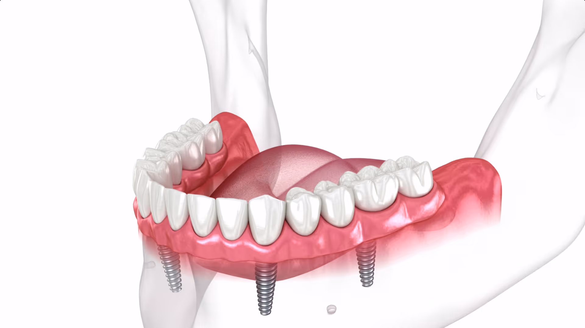 all-on-4-dental-implants-fairfield-ct