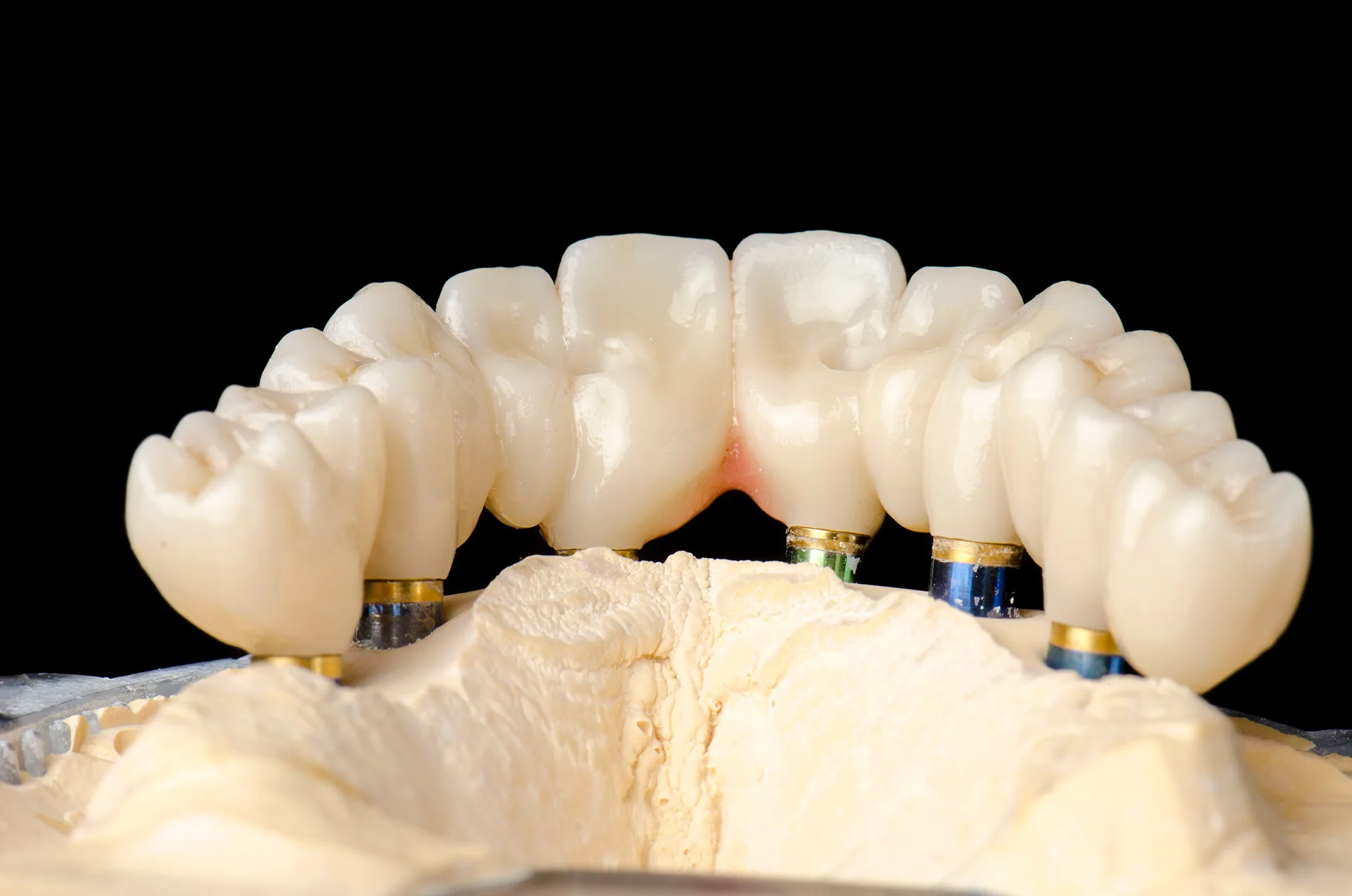 Full-Arch Implant Rehabilitation in Oakland
