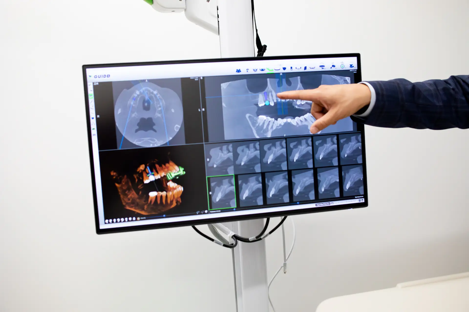 Dental Implants in Oakland 