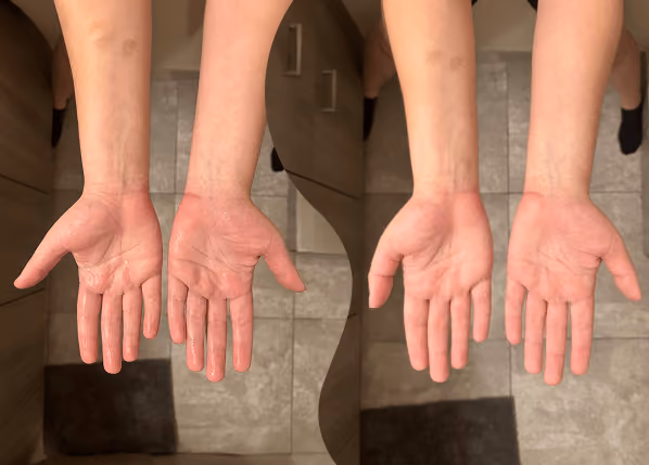 before & after comparison of hand sweat