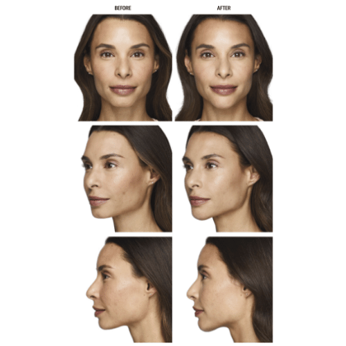 Before and after comparison of a woman's face from front and side views showing smoother skin and enhanced facial contours after treatment.