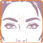 Illustration of a woman's face focusing on glabellar lines between the eyebrows.