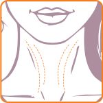 Illustration of a woman's lower face and neck with dotted lines indicating areas for cosmetic or medical treatment on the neck.