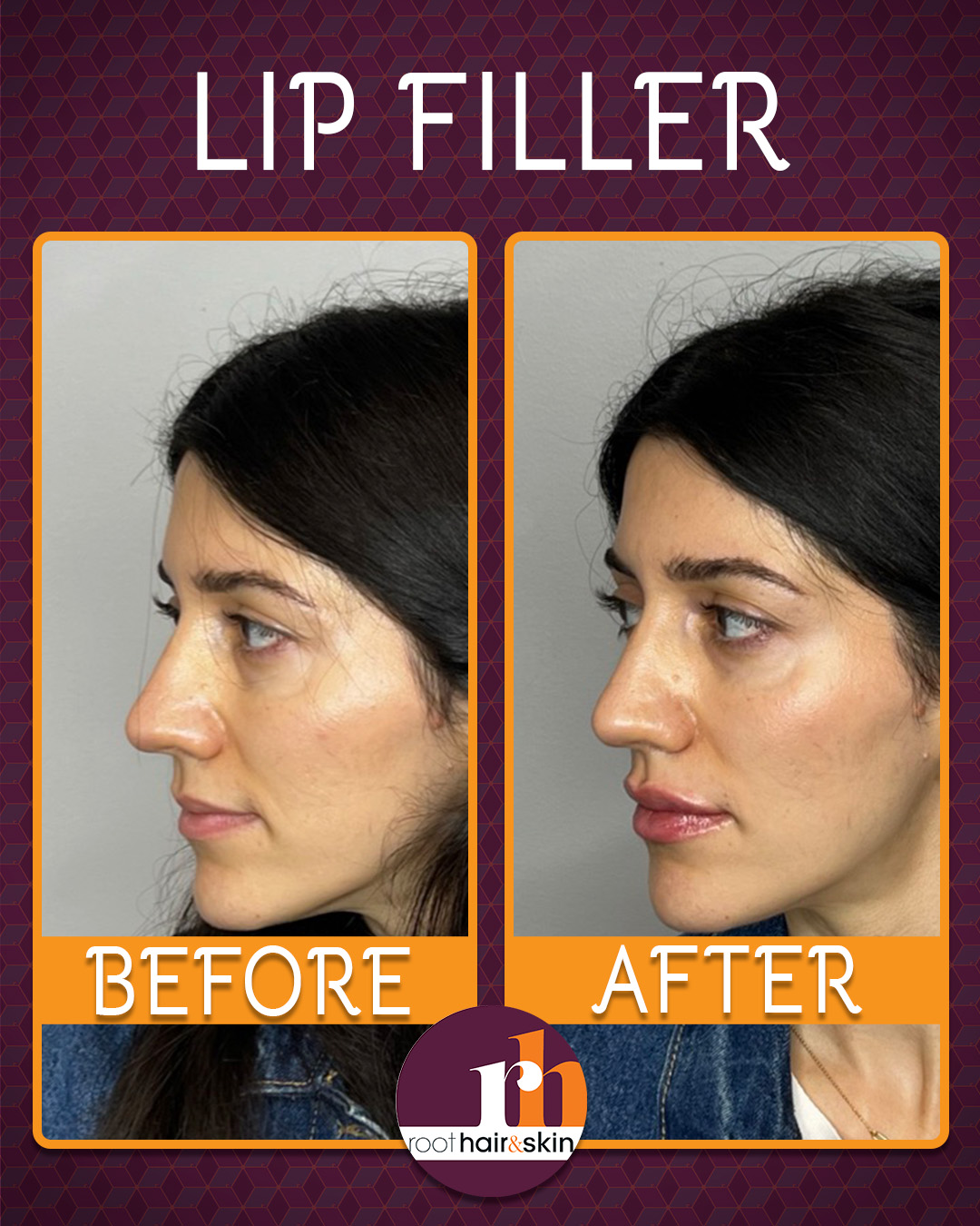 Profile of a woman with dark hair showing jawline after filler treatment against a gray background.