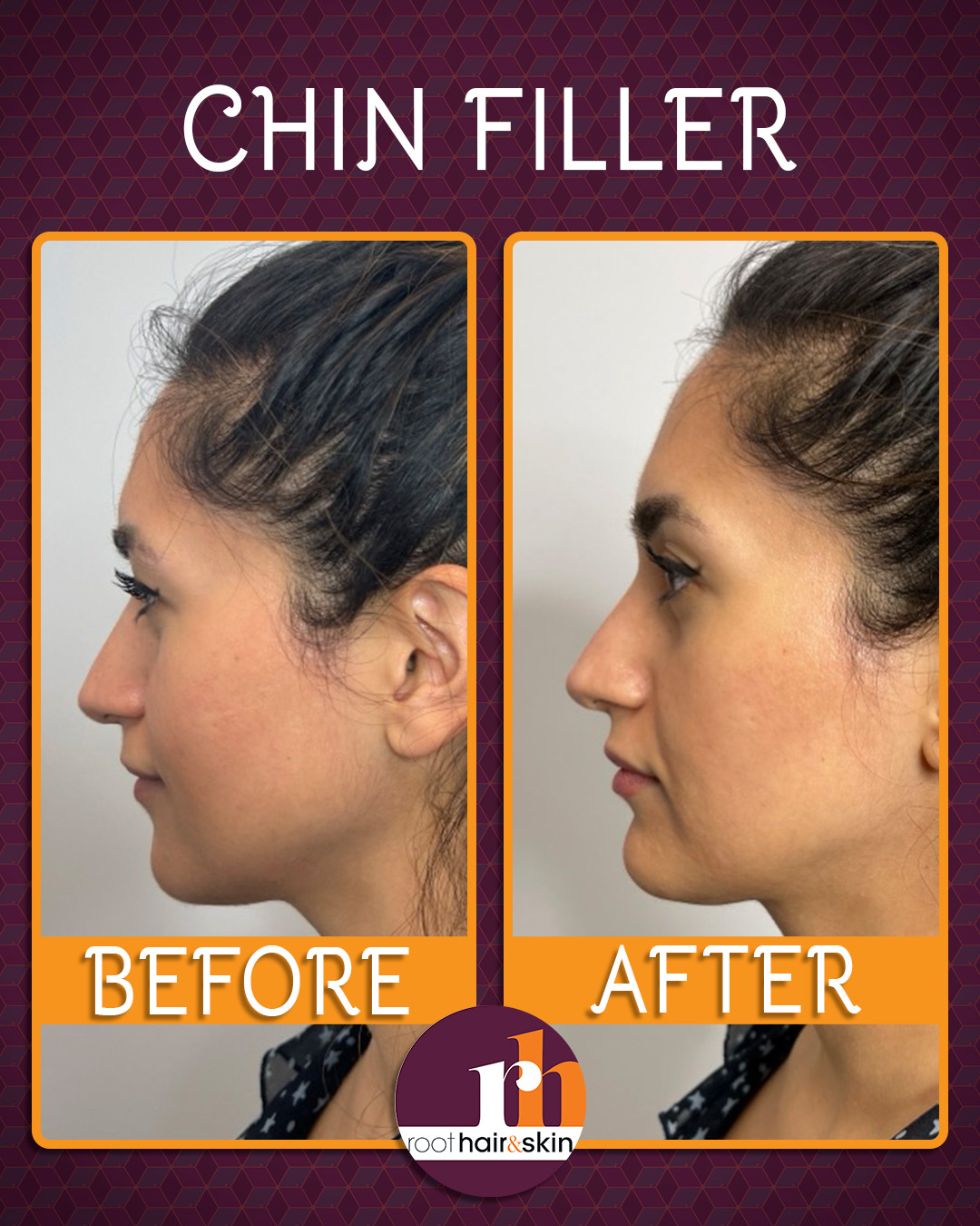 Profile of a woman with dark hair showing jawline after filler treatment against a gray background.