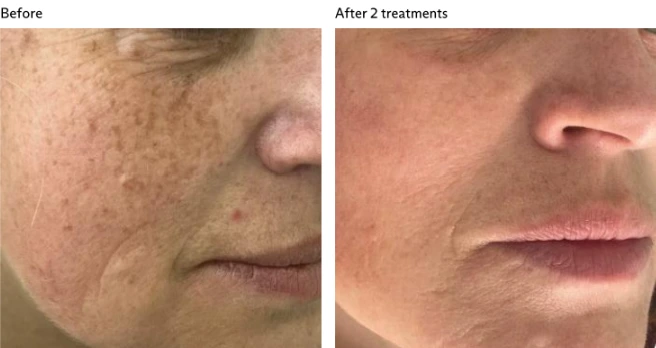 Side-by-side comparison of a person's cheek and mouth area, showing skin with dark spots and uneven texture before treatment and noticeably clearer, smoother skin after two treatments.