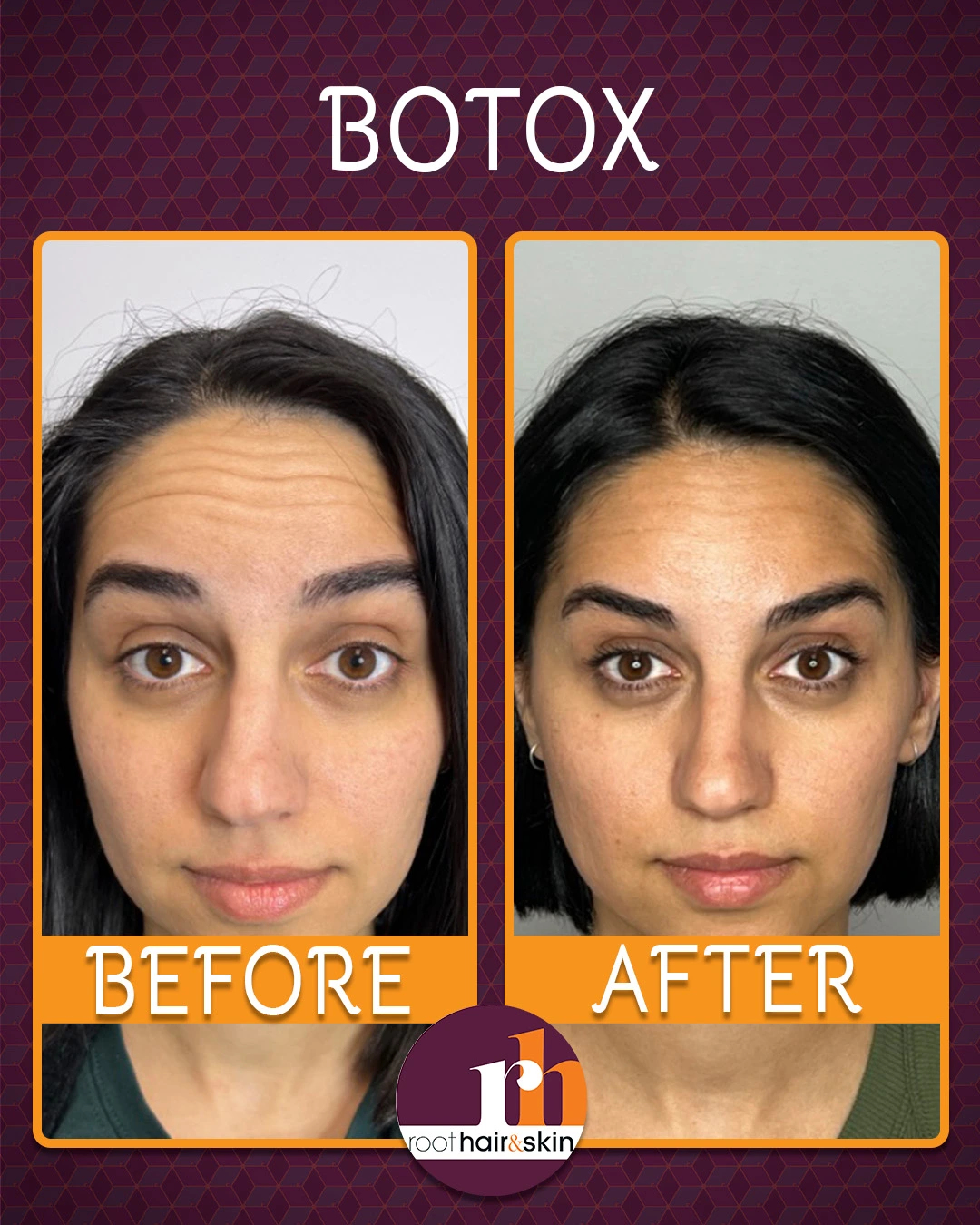 Middle-aged woman with blonde and dark hair, clear skin, and minimal facial wrinkles after Botox treatment.
