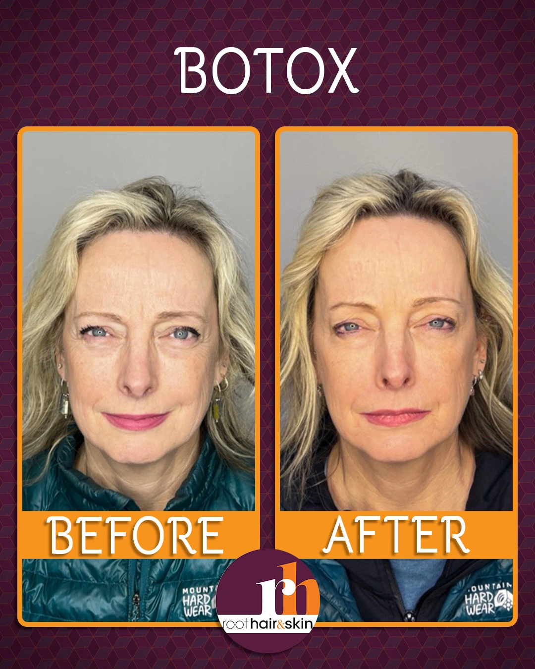 Portrait of a middle-aged woman with blonde hair and blue eyes wearing a teal jacket, labeled Botox before treatment.