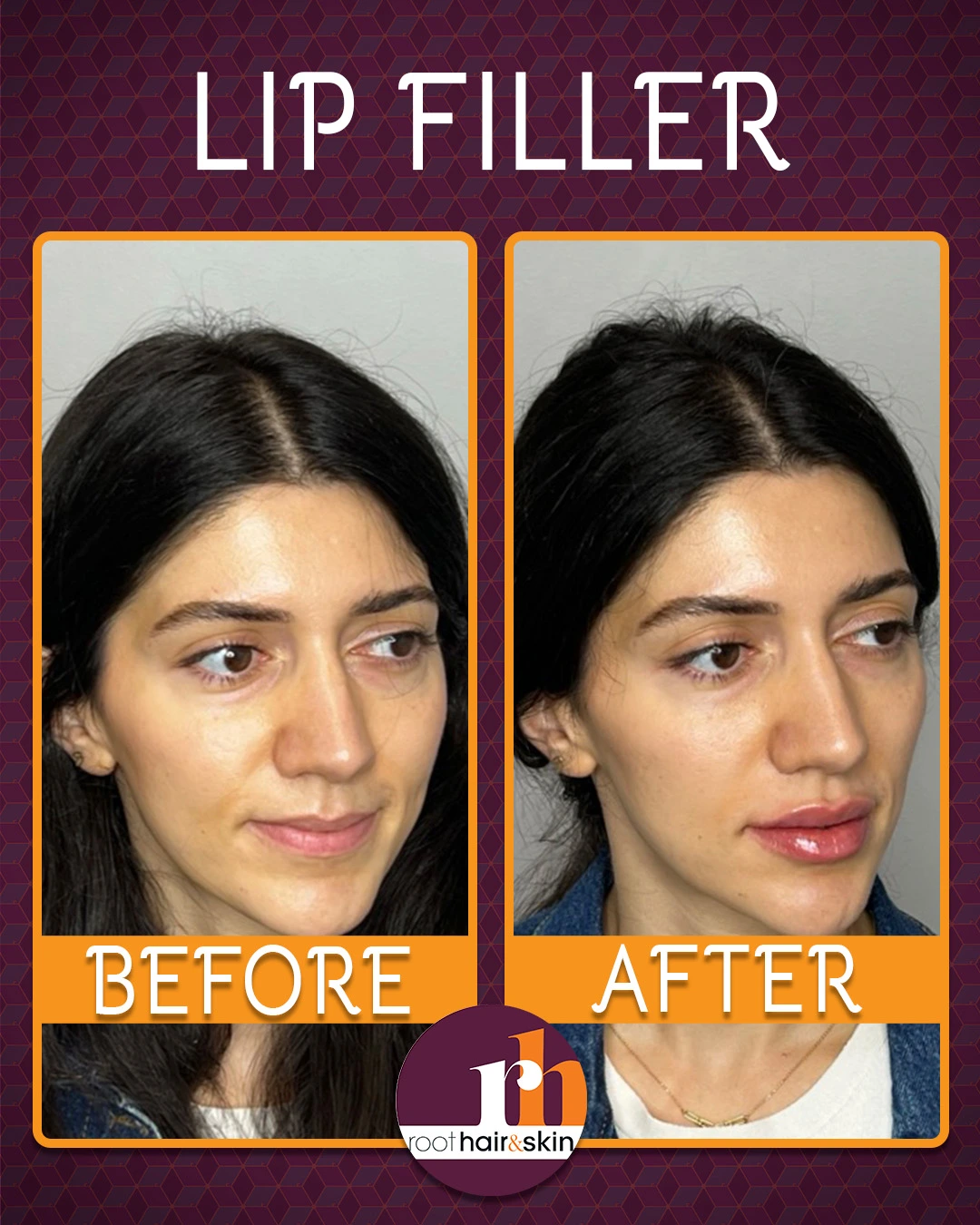 Profile of a woman with dark hair showing jawline after filler treatment against a gray background.