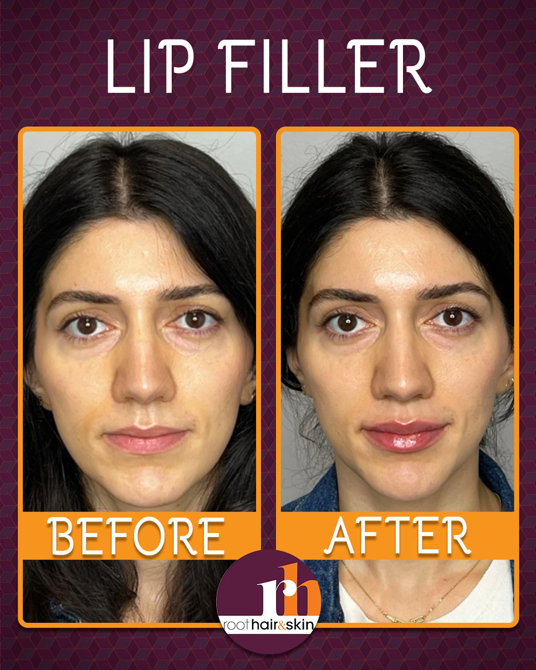Profile of a woman with dark hair showing jawline after filler treatment against a gray background.