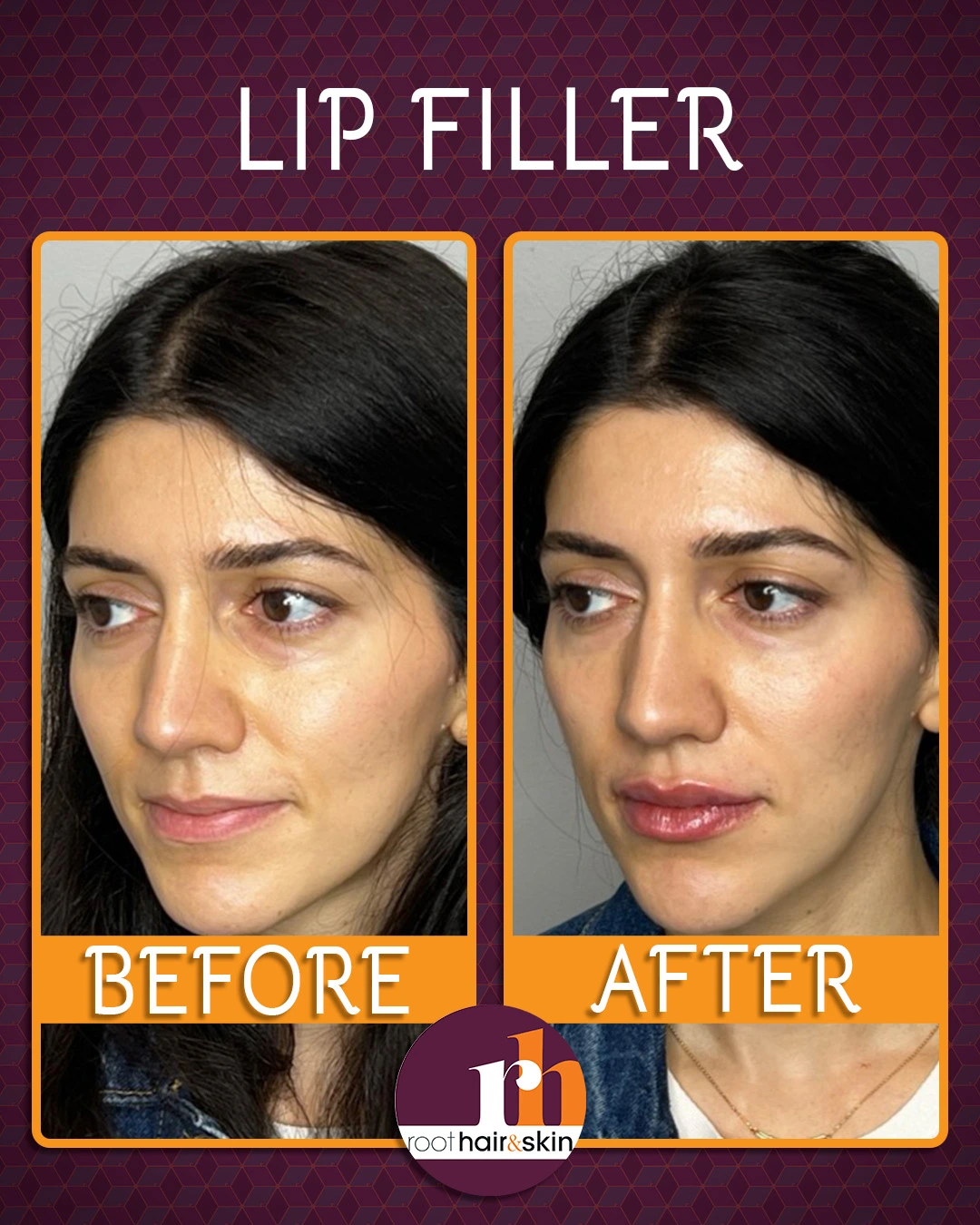 Profile of a woman with dark hair pulled back, showing the natural shape of her jawline before filler treatment.