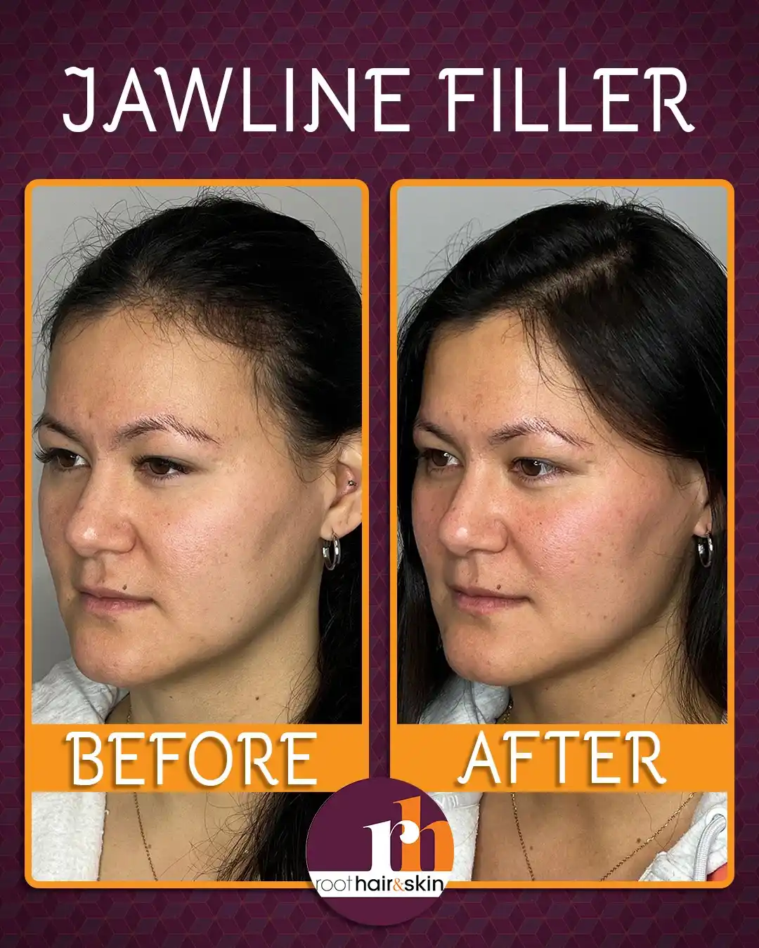 Profile of a woman with dark hair showing jawline after filler treatment against a gray background.
