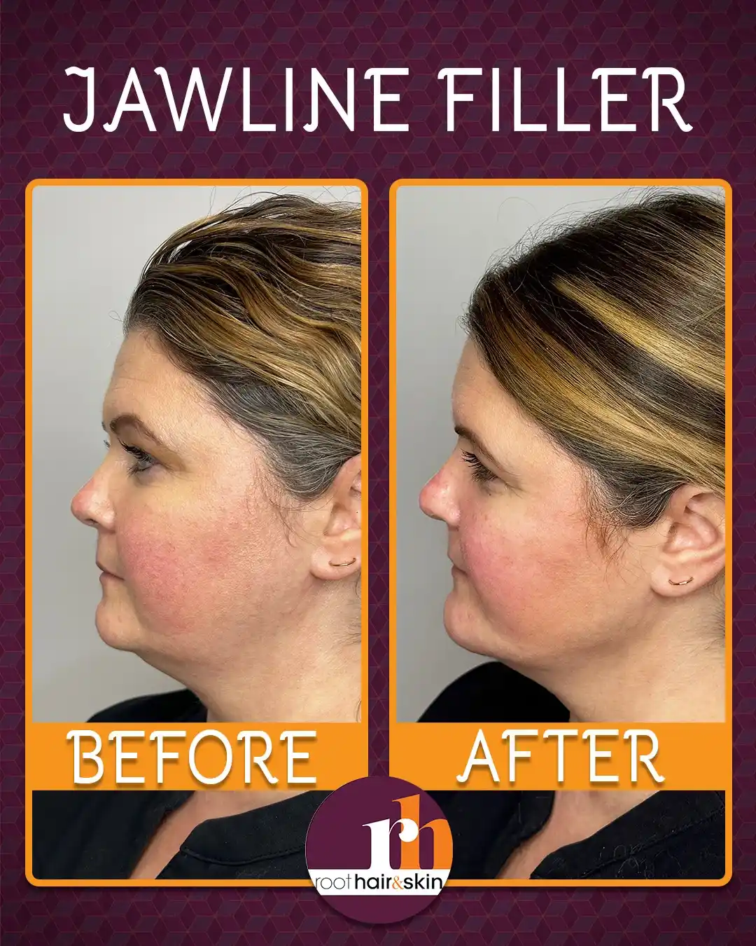 Profile of a woman with dark hair showing jawline after filler treatment against a gray background.