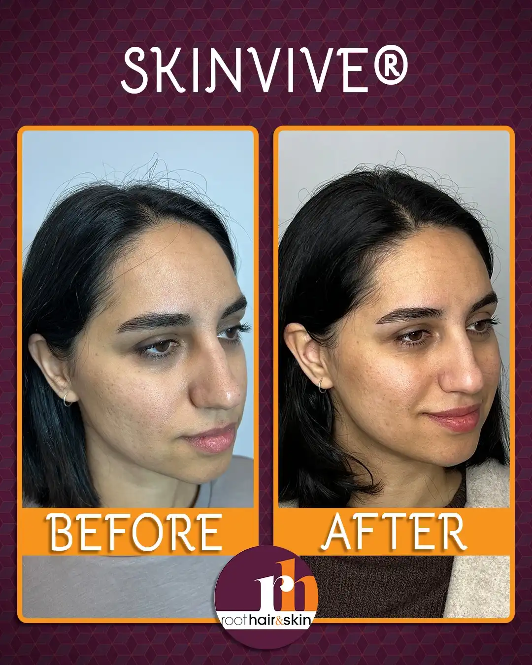 Profile of a woman with dark hair showing jawline after filler treatment against a gray background.