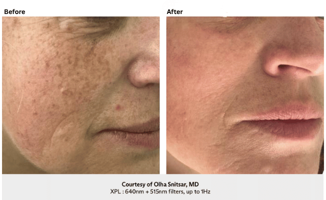 Side-by-side comparison of a person's cheek and mouth area, showing skin with dark spots and uneven texture before treatment and noticeably clearer, smoother skin after two treatments.