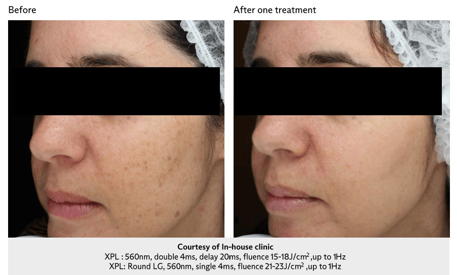 Profile of a woman with dark hair showing jawline after filler treatment against a gray background.