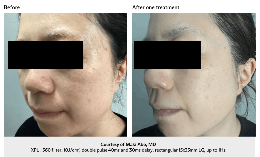 Profile of a woman with dark hair showing jawline after filler treatment against a gray background.