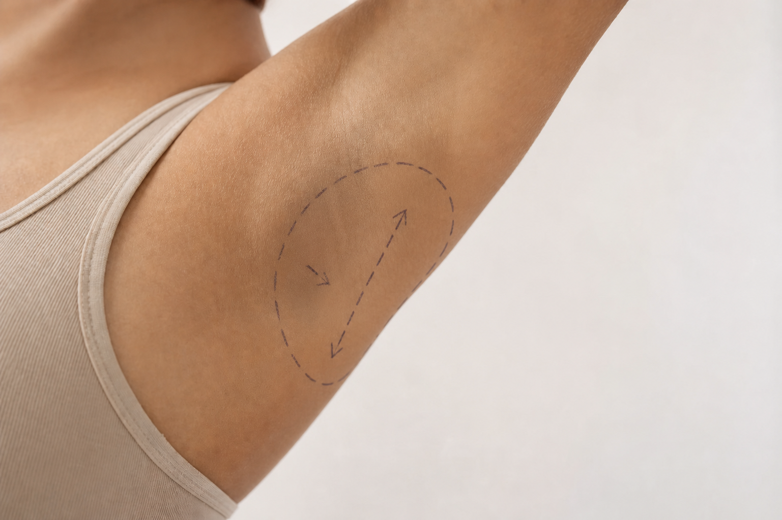 A close-up of a modern handheld medical device being gently applied to the underarm area of a person's skin, soft clinical lighting, clean and sterile environment, professional dermatology setting, no text or labels, photorealistic style