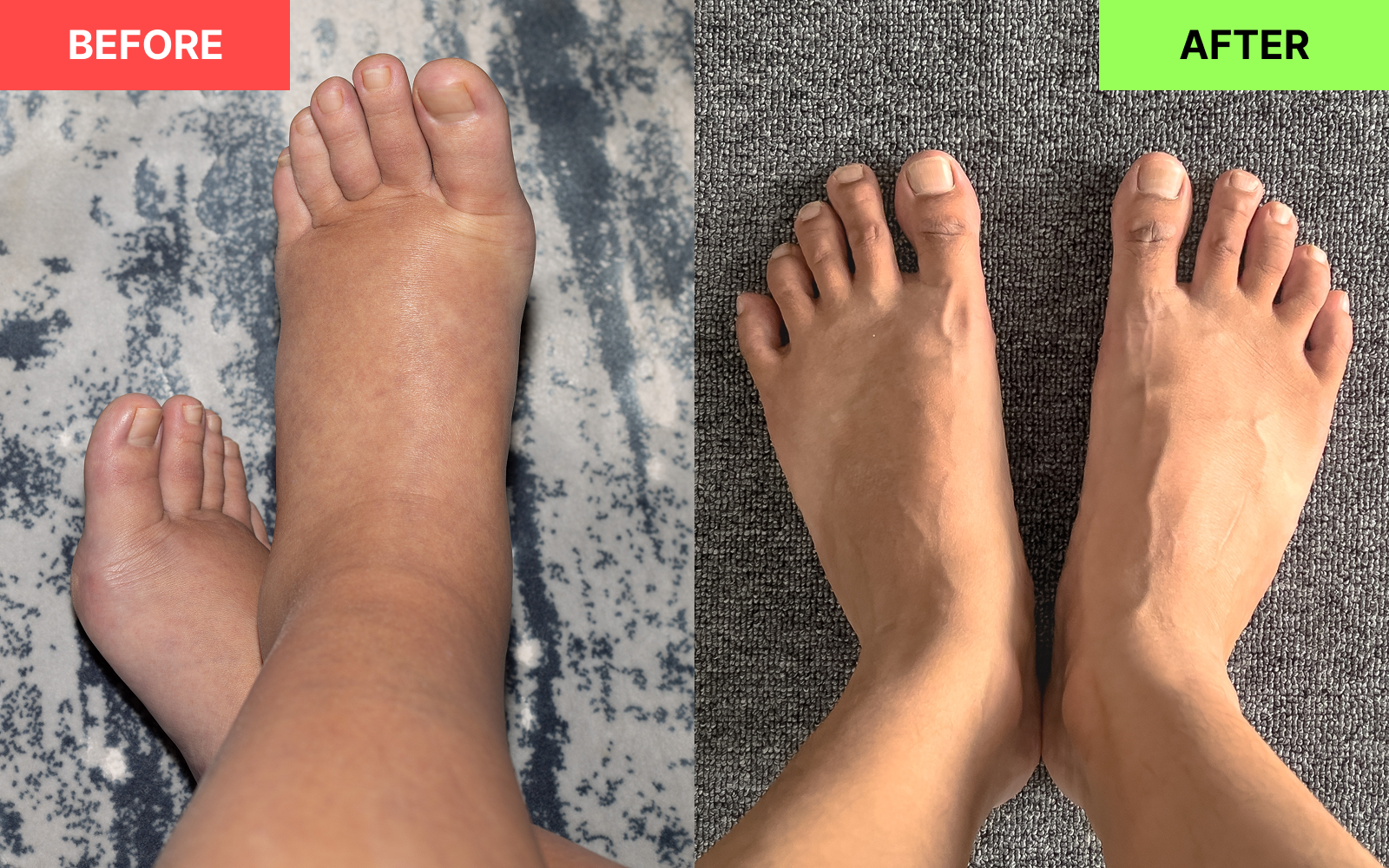 EmPulse heat and EMS combination therapy