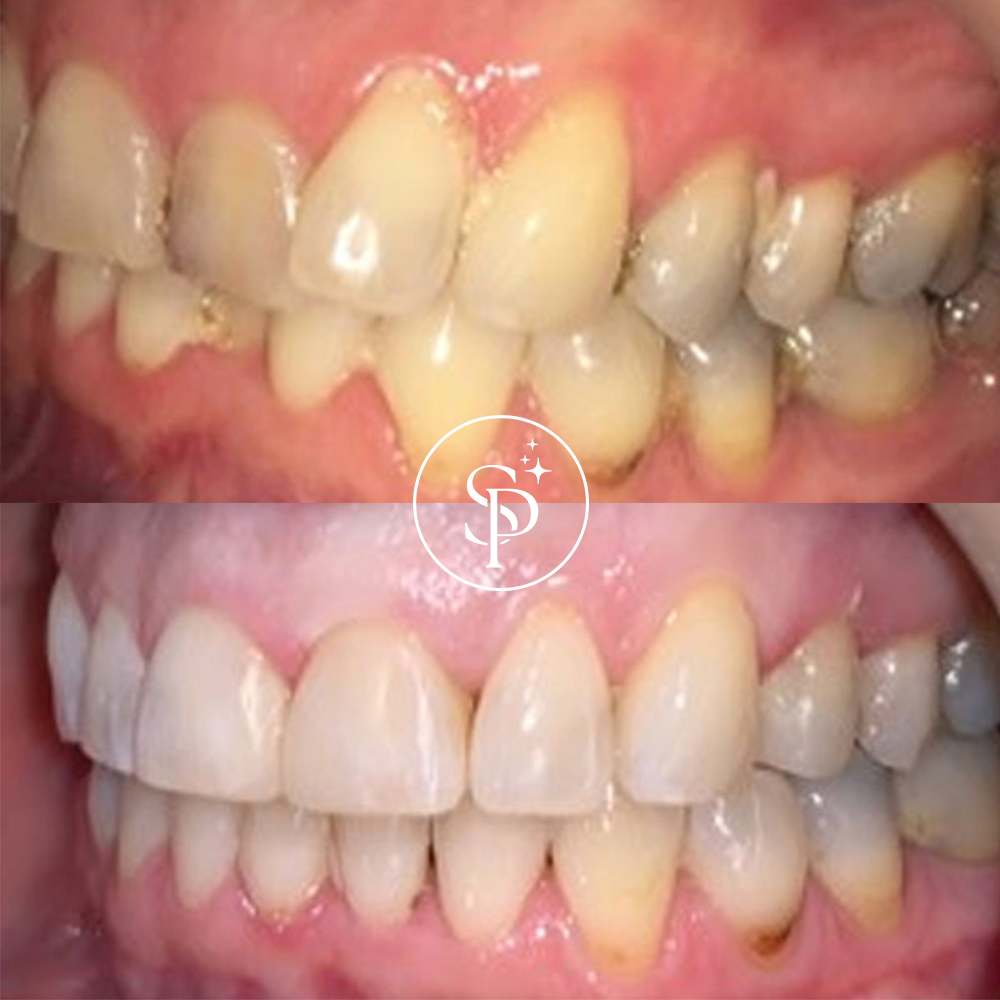 Teeth before and after