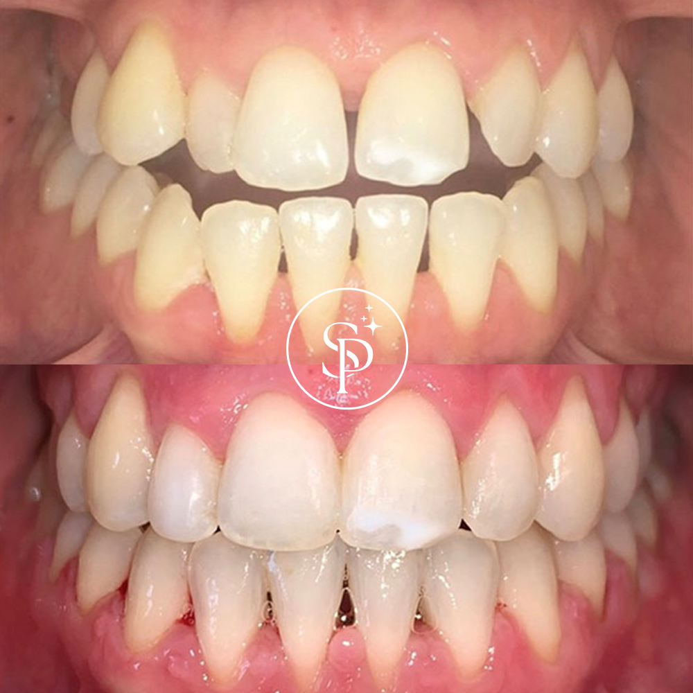 Teeth before and after