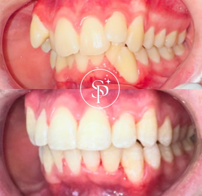 Fastbraces
